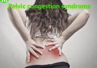 Pelvic congestion syndrome copy