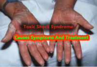 Toxic shock syndrome causes symptoms and treatment